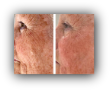 Radio Frequency Facials